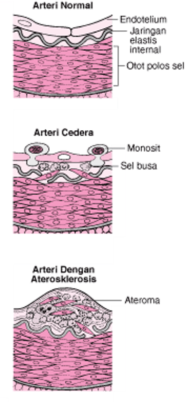 Bagaimana Aterosklerosis Berkembang