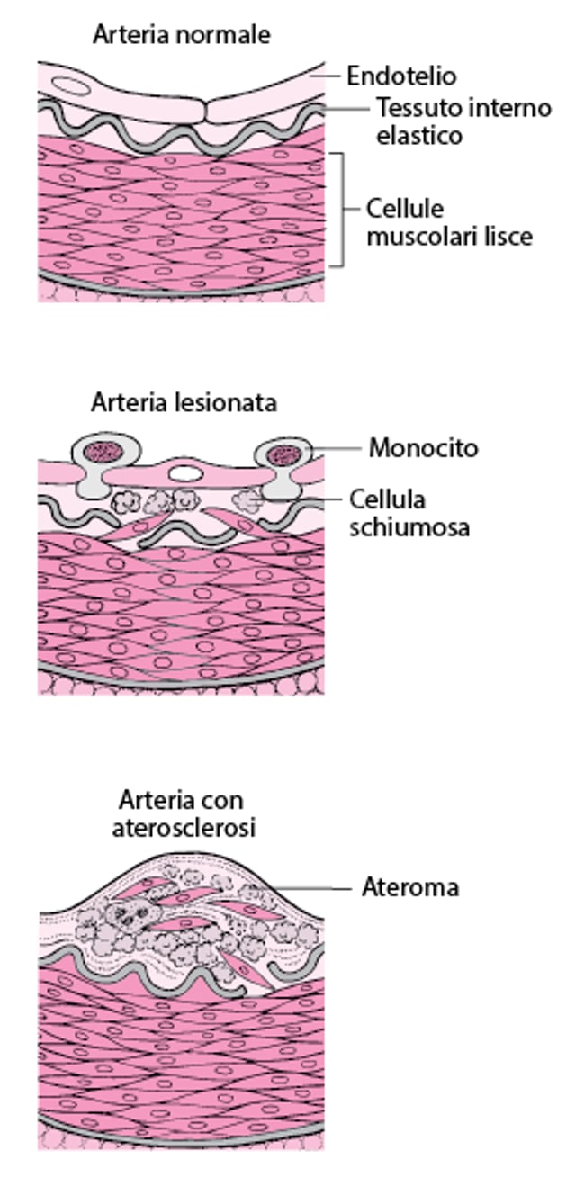 Modalità di sviluppo dell’aterosclerosi