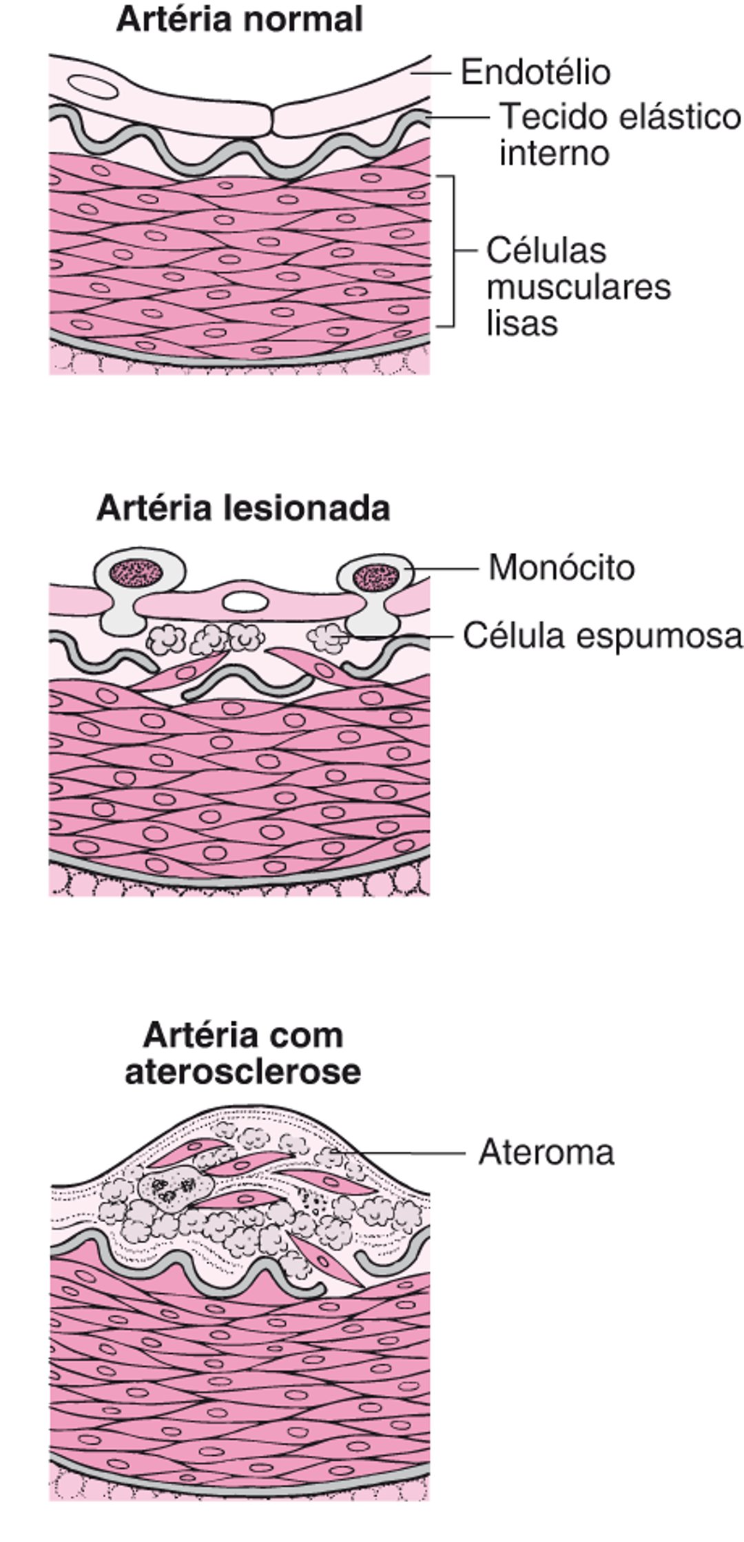 Como a aterosclerose se desenvolve