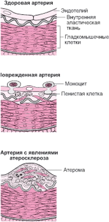 Как развивается атеросклероз