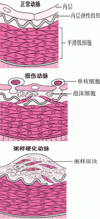 动脉粥样硬化如何形成