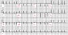 Fibrillation atriale