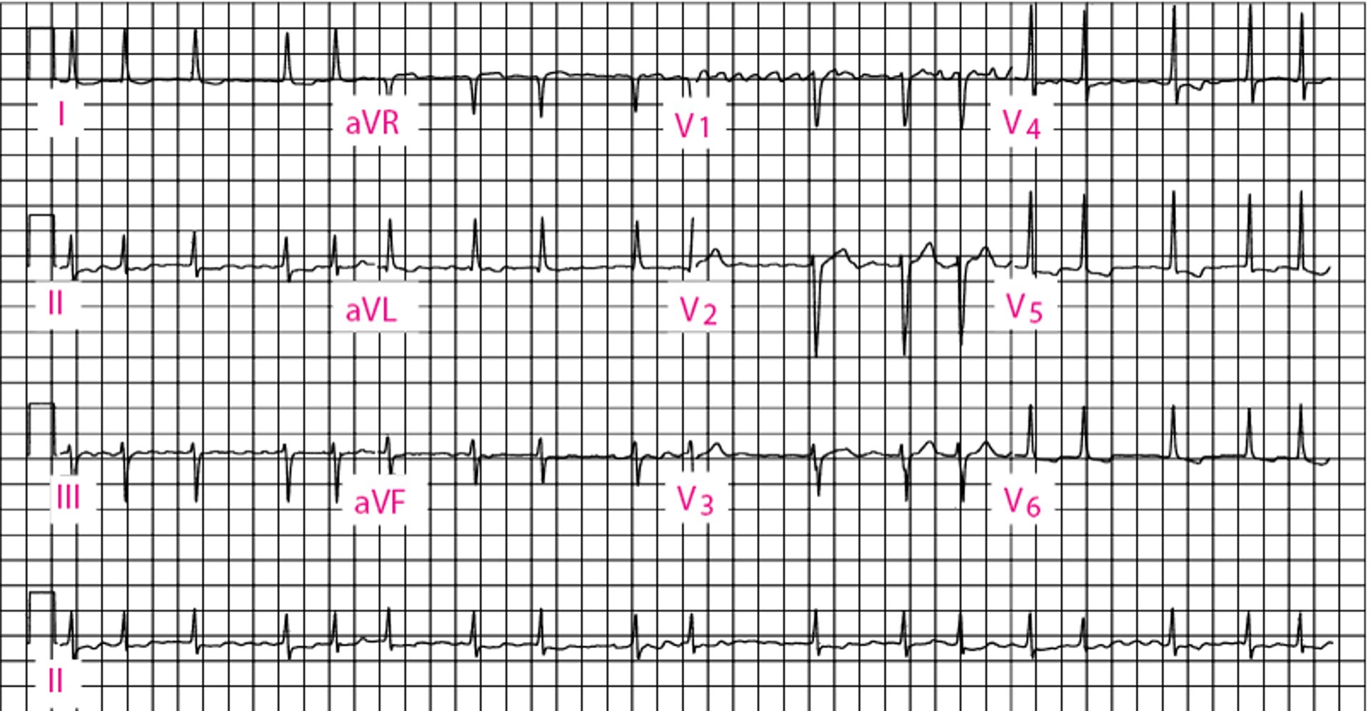 Fibrillation atriale
