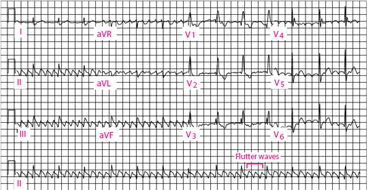 Atrial Flutter