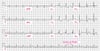 Flutter atrial