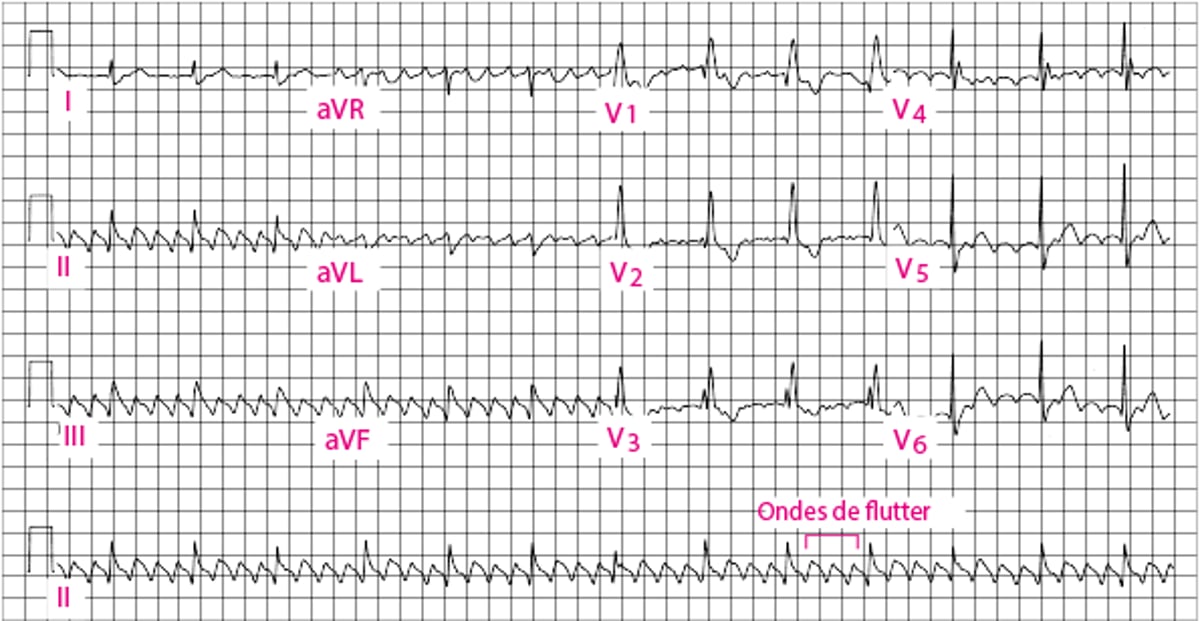 Flutter atrial