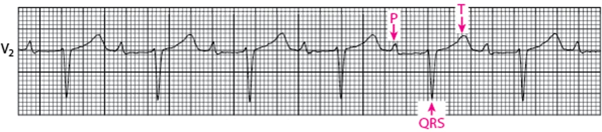 First-degree Atrioventricular Block