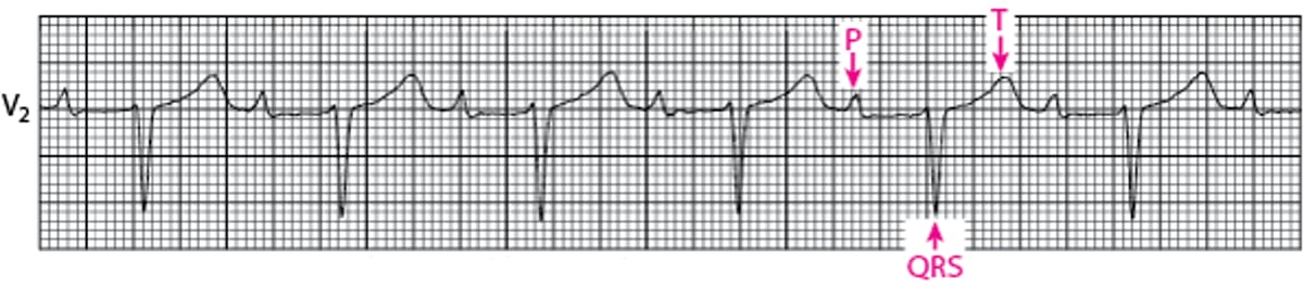 First-Degree Atrioventricular Block