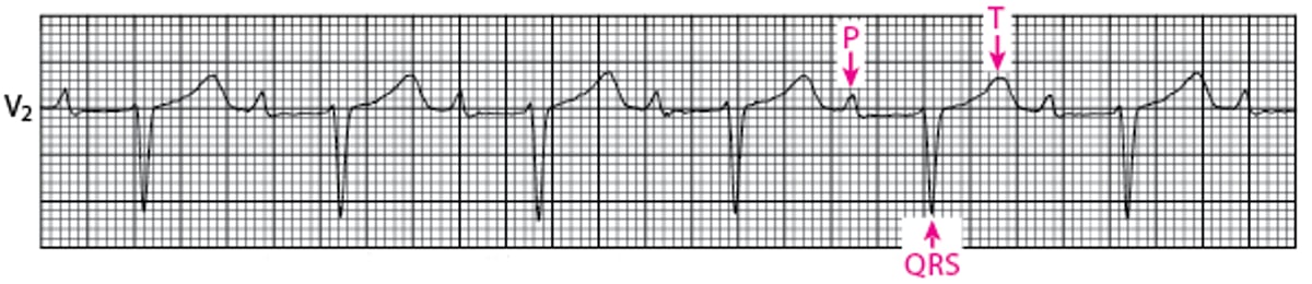 Bloqueo auriculoventricular de primer grado