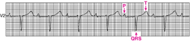 फर्स्ट-डिग्री एट्रियोवेंट्रिकुलर ब्लॉक