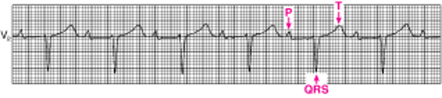 Penyumbatan Atrioventrikular Tingkat Pertama