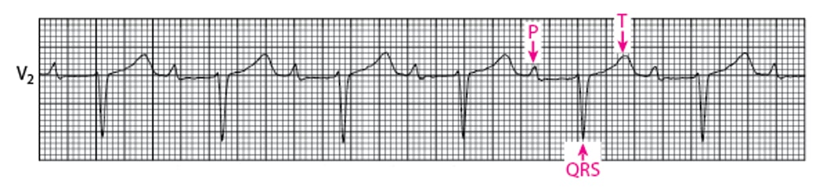 ImageBlocco atrioventricolare di primo gradoManuale MSD, versione per
