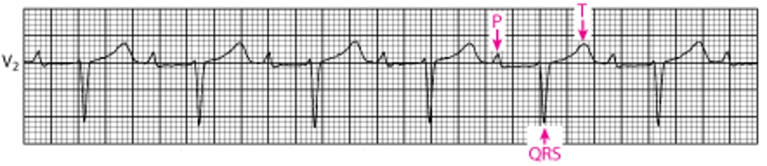 Bloqueio atrioventricular de primeiro grau