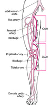 Bypass Surgery in the Leg