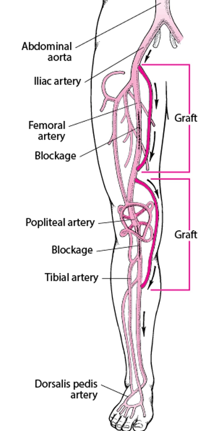 Bypass Surgery in the Leg
