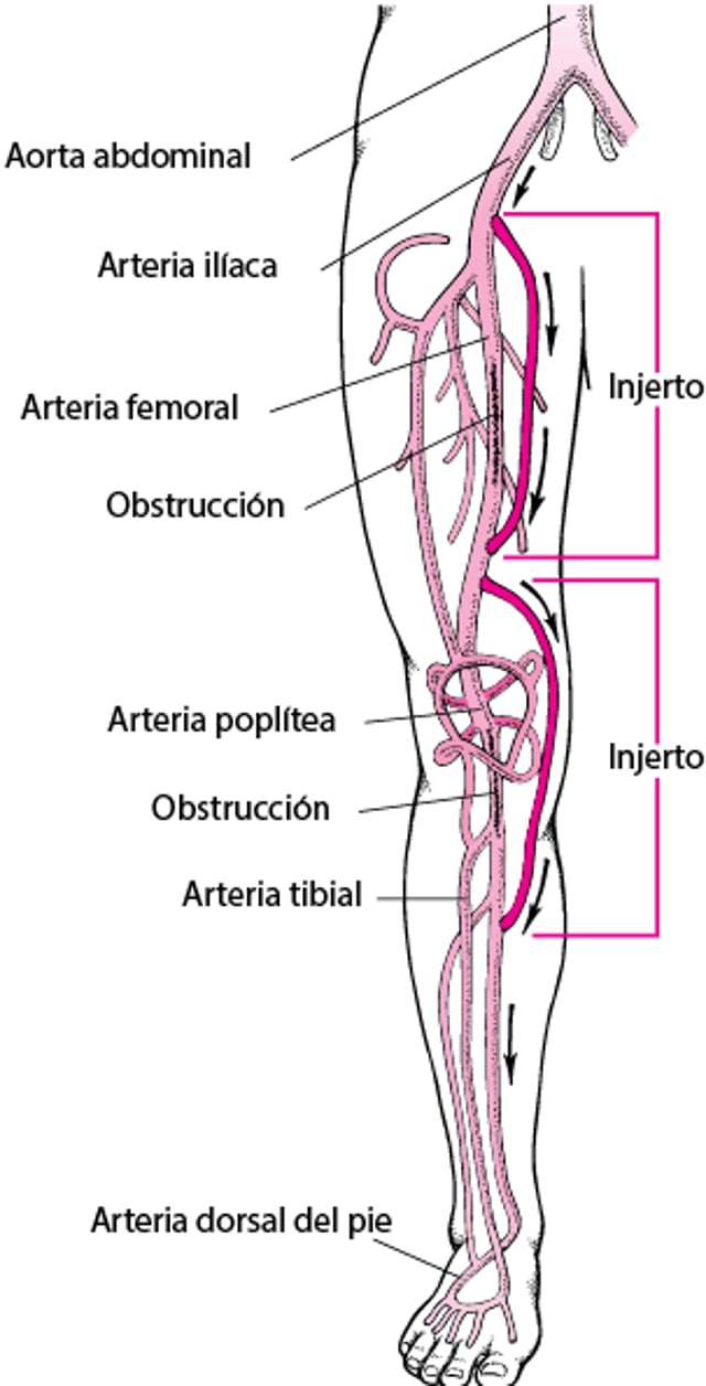 Cirugía de revascularización (bypass) en la pierna