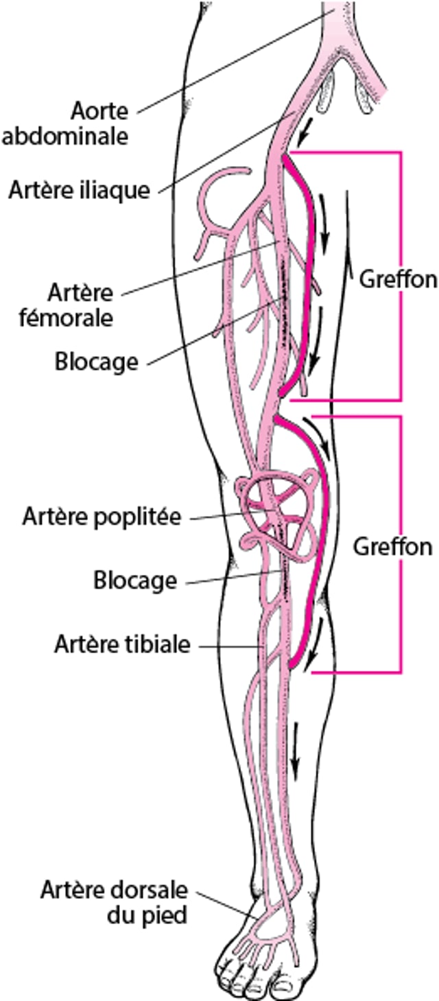 Pontage de la jambe