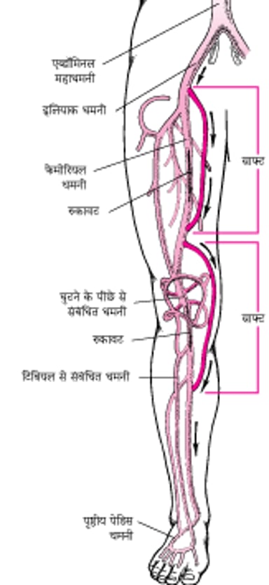 पैर में बायपास सर्जरी