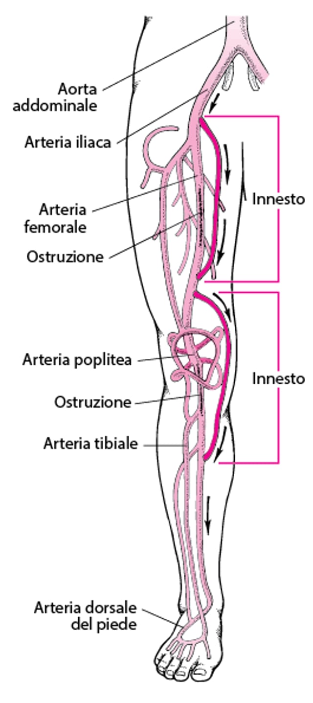 Intervento di bypass degli arti inferiori