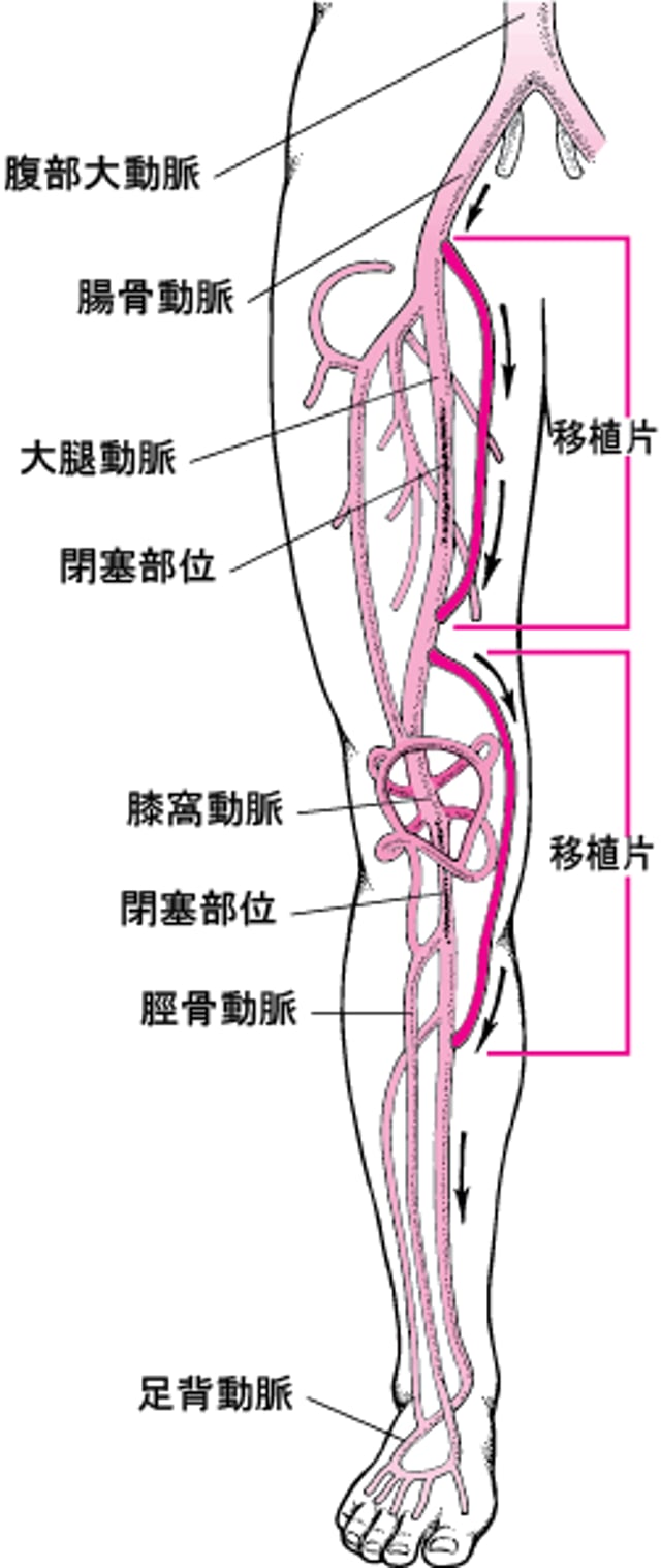 脚のバイパス手術