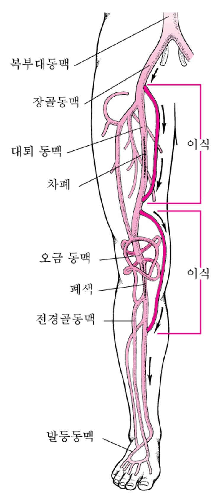 다리의 우회로 수술