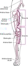 Cirurgia de revascularização na perna