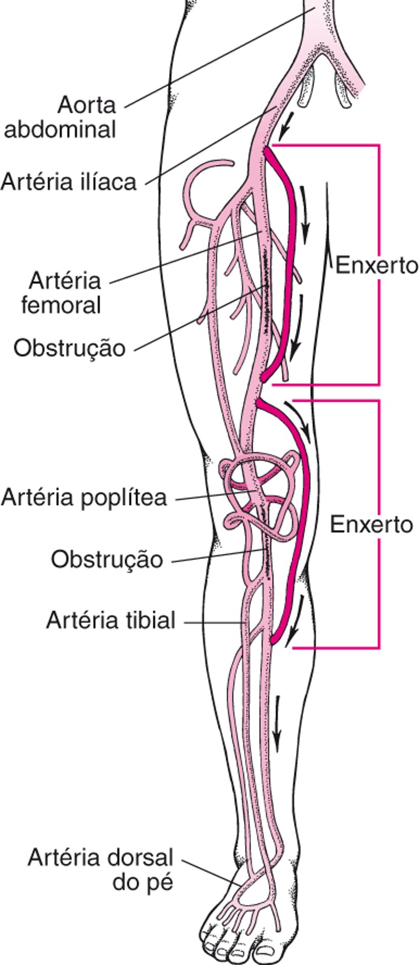 Cirurgia de revascularização na perna