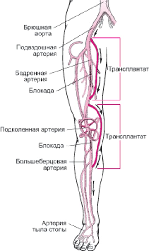 Операция шунтирования на сосудах ног