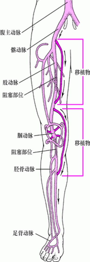 腿部的旁路手术