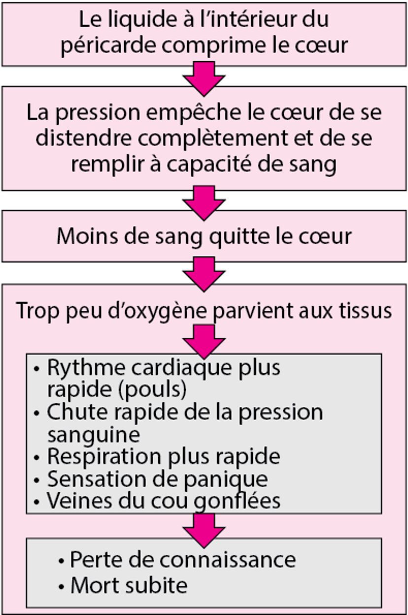 Tamponnade cardiaque