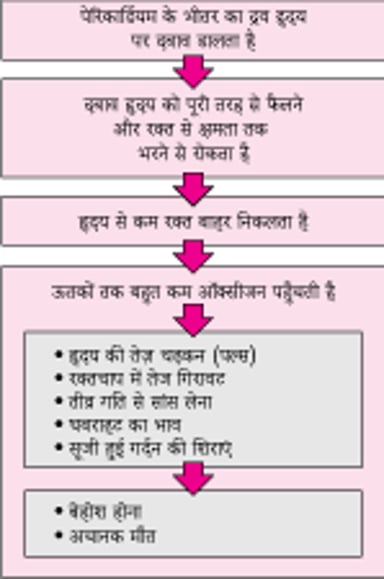 कार्डियाक टैंपोनेड