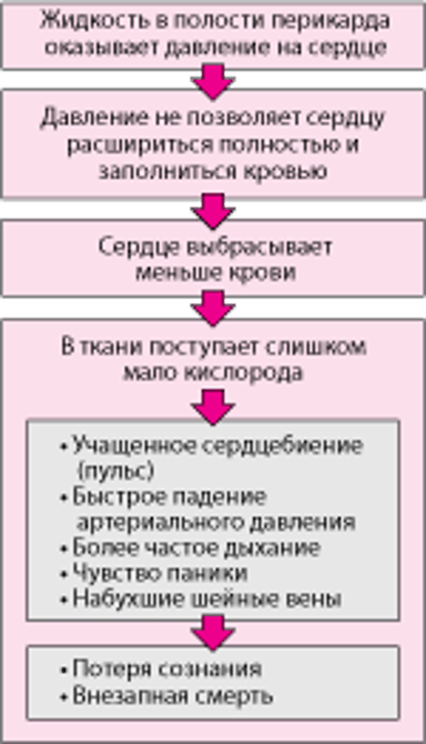 Тампонада сердца
