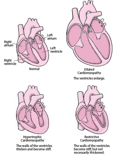 Types of Cardiomyopathy