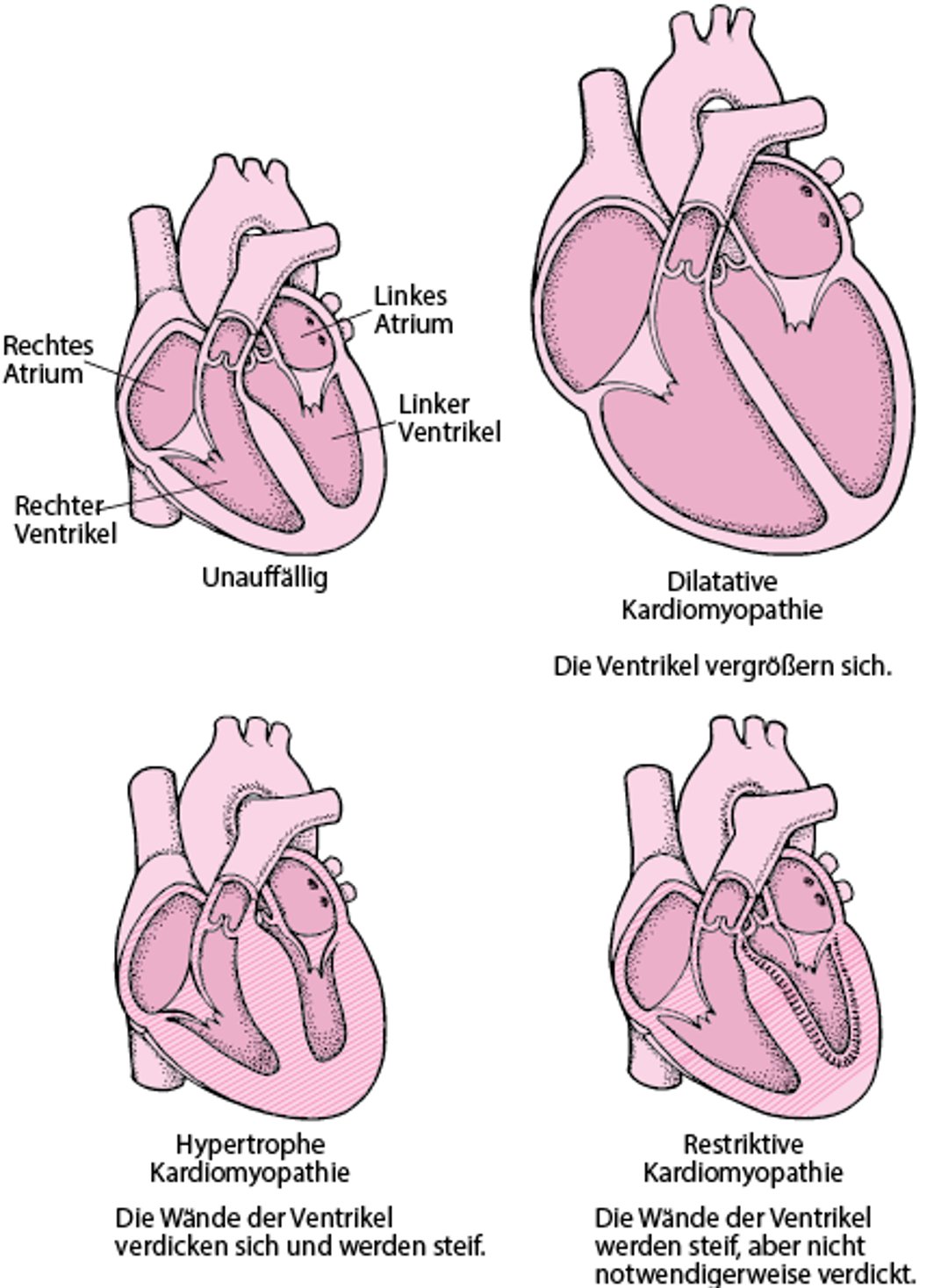 Formen von Kardiomyopathie