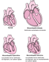Tipos de miocardiopatías