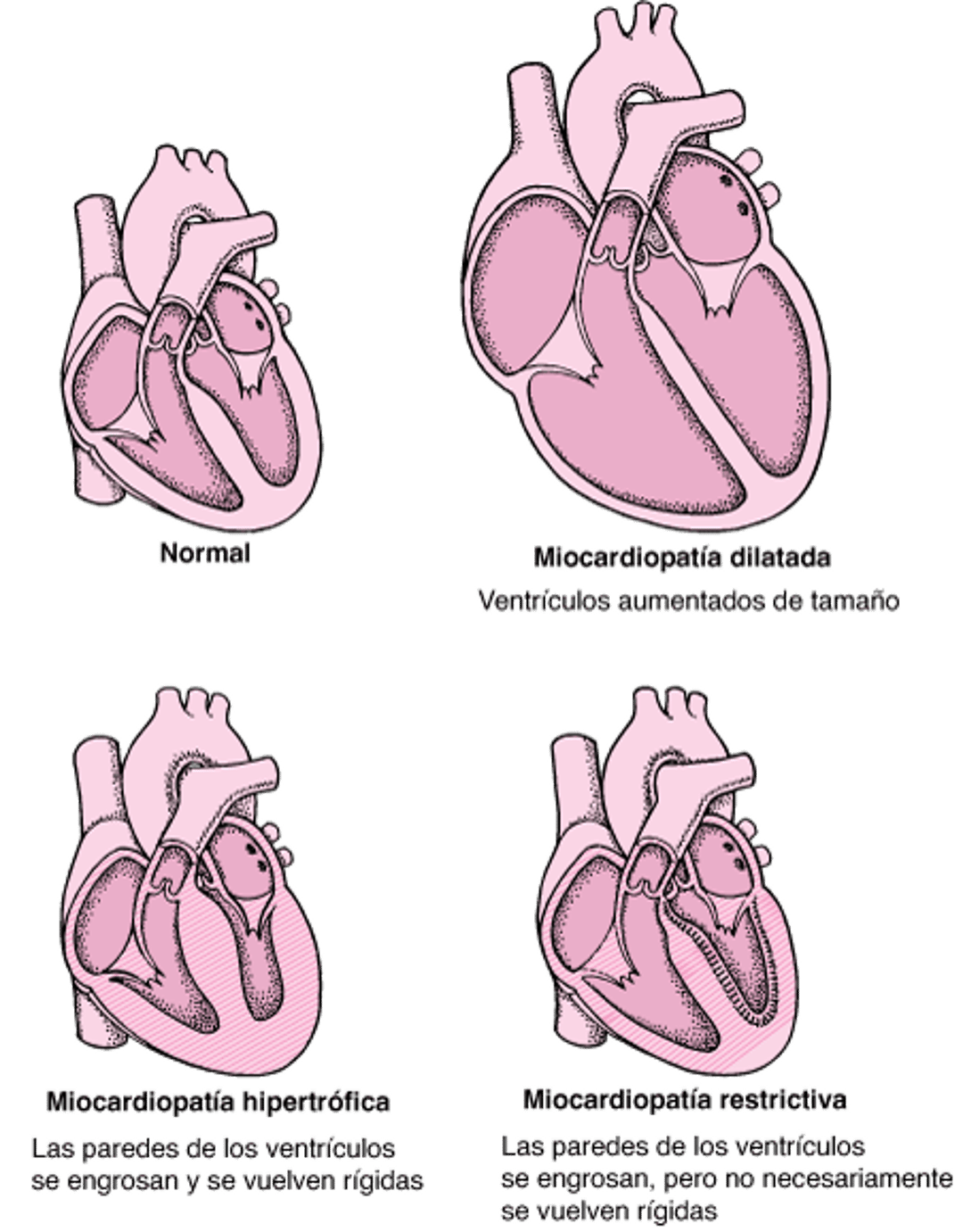 Tipos de miocardiopatías