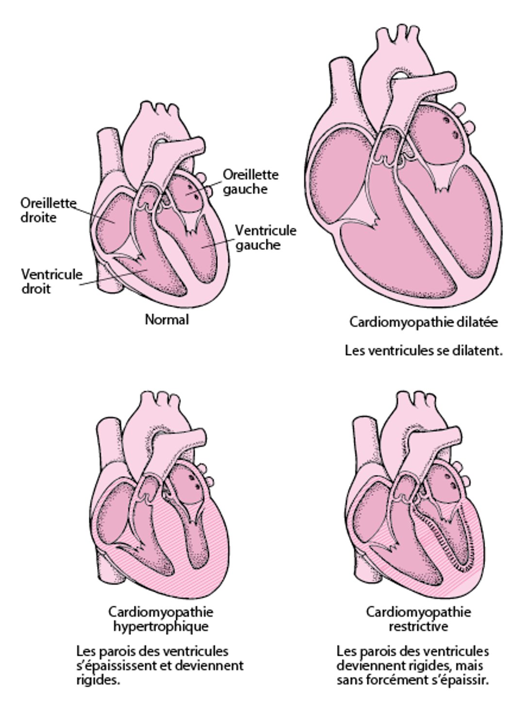 Types de cardiomyopathie