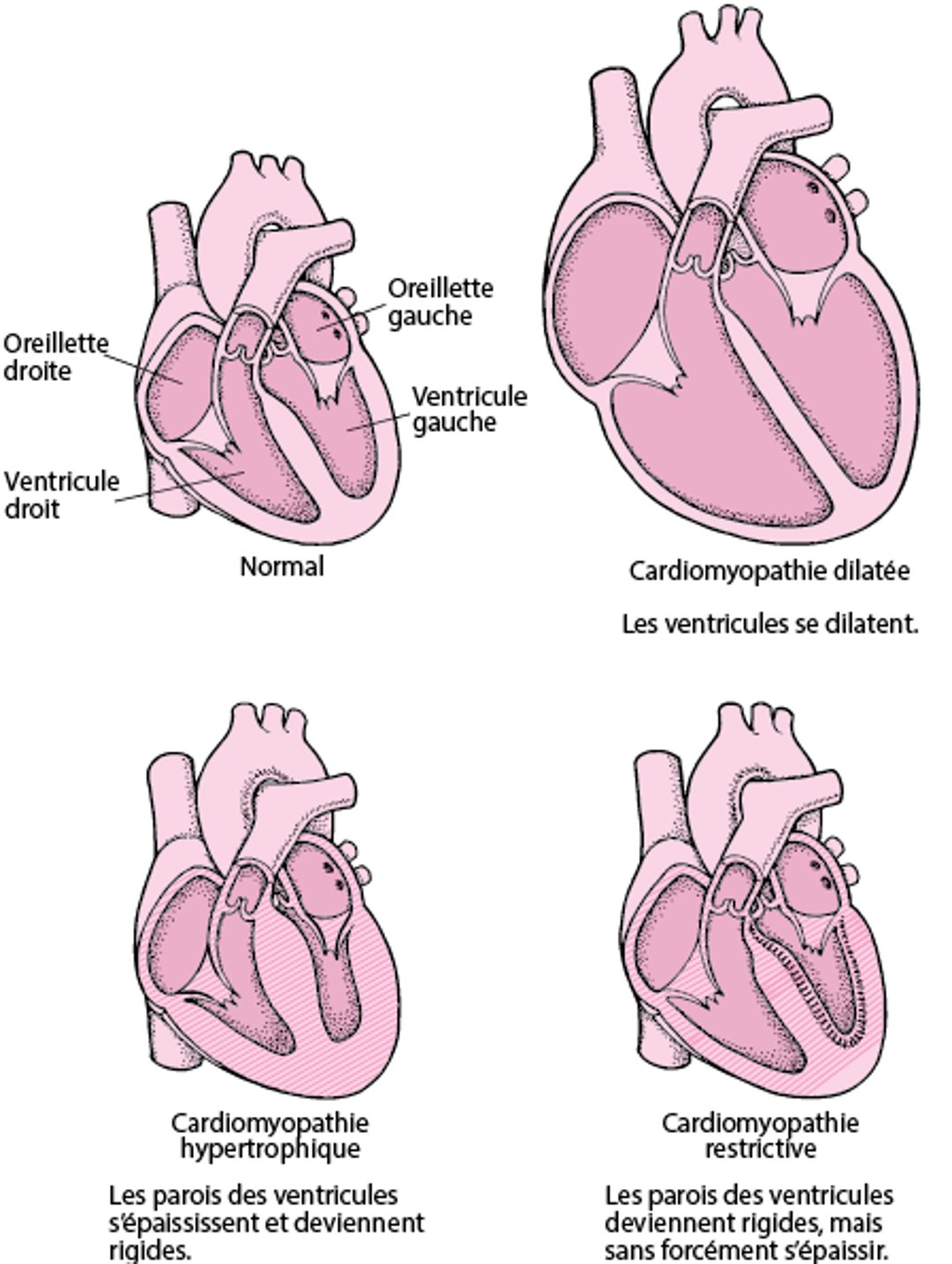 Types de cardiomyopathie