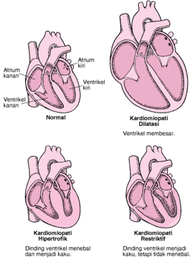 Jenis Kardiomiopati