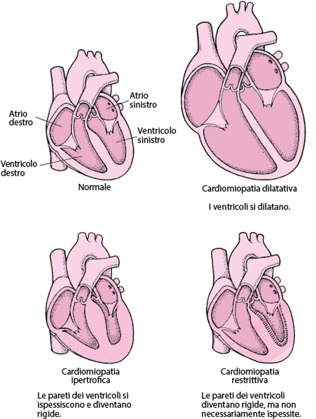 Tipi di cardiomiopatia