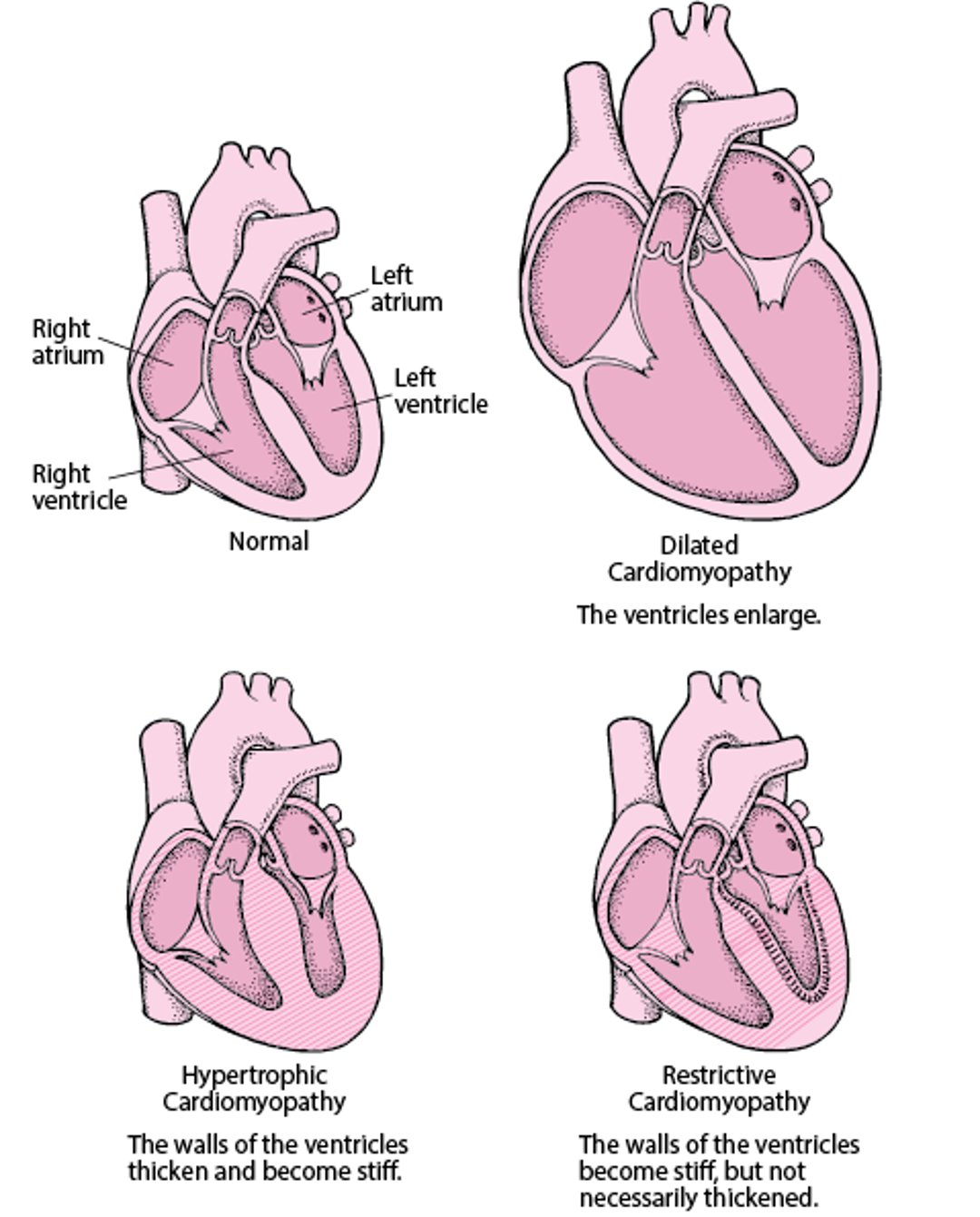 Types de cardiomyopathie