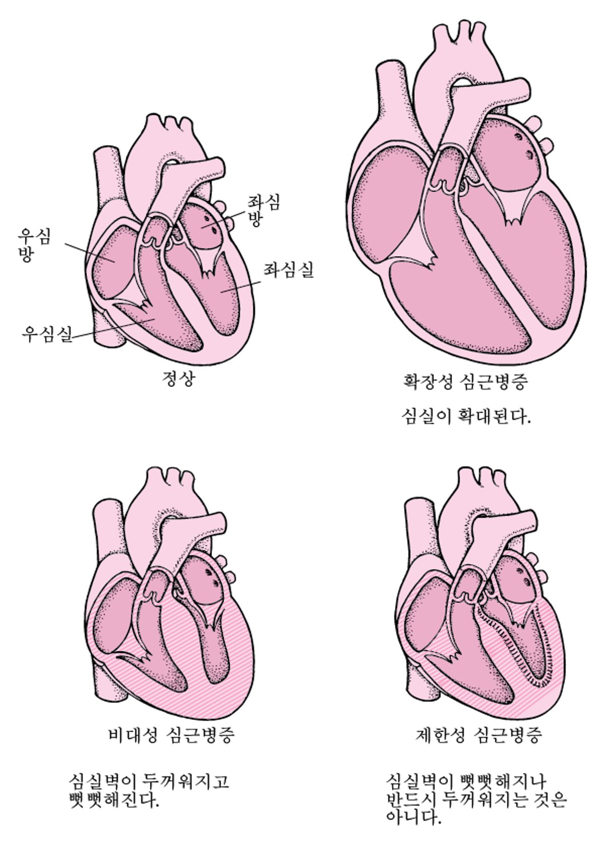 심근병증의 유형