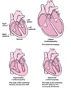 Tipos de cardiomiopatia