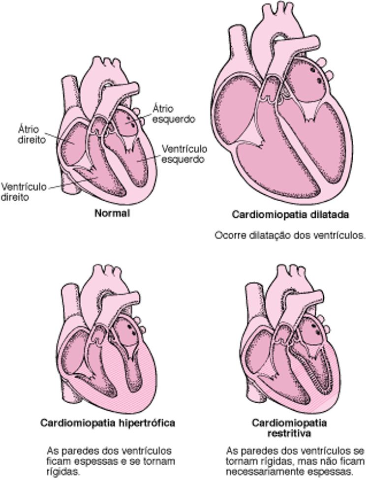 Tipos de cardiomiopatia