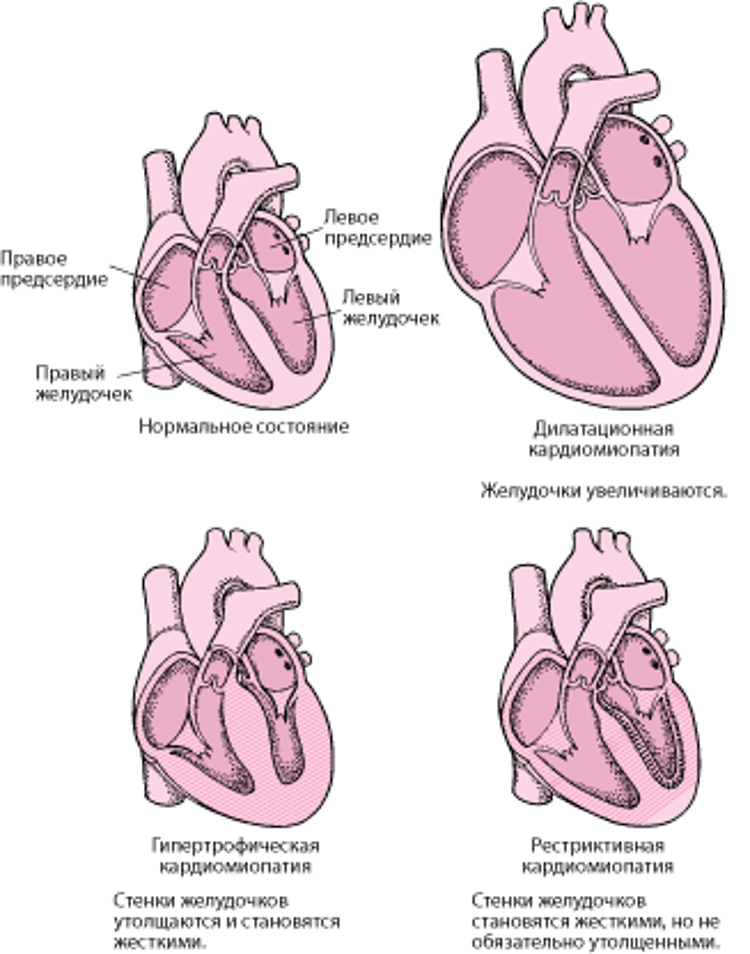 Типы кардиомиопатии