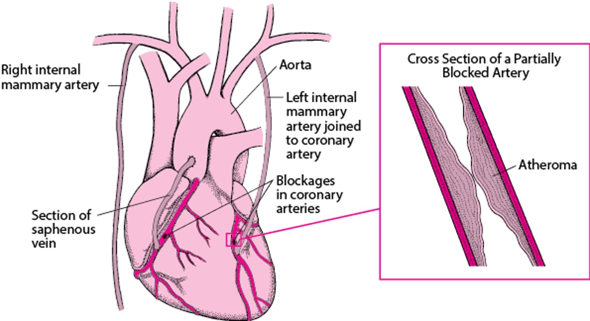 Coronary Artery Bypass Grafting