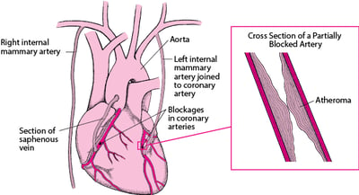 Coronary Artery Bypass Grafting