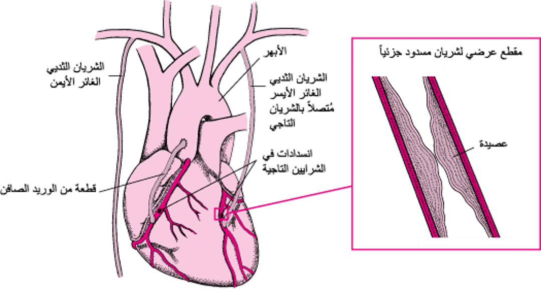 وضعُ طُعم مَجازَة الشريان التاجي Coronary Artery Bypass Grafting