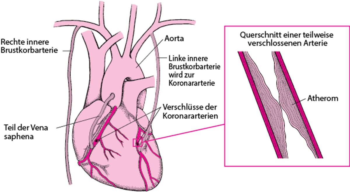 Koronararterien-Bypassoperation