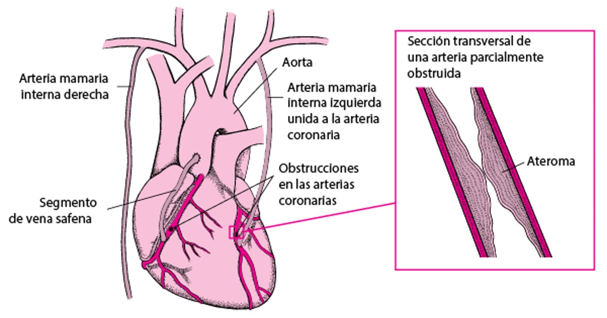 Injertos de revascularización coronaria (bypass coronario)